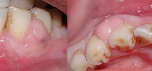 Gingival Abscess