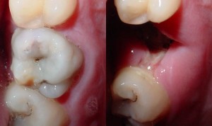 Dental Caries